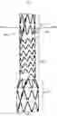 Fig. 08 - SEGMENTED COVERED STENT AND PREPARATION METHOD THEREFOR