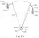 Fig. 17 - Coaptation enhancement implant, system, and method