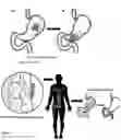 Fig. 02 - METHOD OF TREATMENT AND DEVICE FOR THE IMPROVED BIOAVAILABILITY OF LEUKOTRIENE RECEPTOR ANTAGONISTS