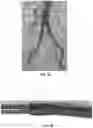 Fig. 04 - ANTI-LOCKING THROMBECTOMY APPARATUSES AND METHODS