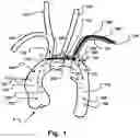 Fig. 02 - Embolic Protection Device And Method
