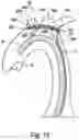 Fig. 09 - Embolic Protection Device And Method