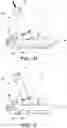 Fig. 07 - Joint replacement prosthesis with trans-cortical stems
