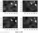 Fig. 12 - Breast calcification imaging phantoms and methods of use
