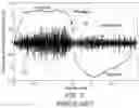 Fig. 07 - Oral device for measuring respiratory sounds