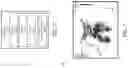 Fig. 03 - Reduction of reverberation artifacts in ultrasound images and associated devices, systems, and methods