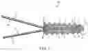 Fig. 02 - Fully-threaded bioabsorbable suture anchor