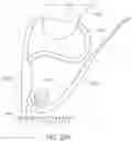 Fig. 33 - Variable denier yarn and suture