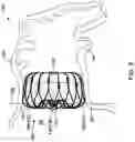 Fig. 06 - Left atrial appendage implant