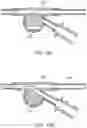Fig. 25 - SYSTEMS AND METHODS FOR NEUROVASCULAR INTERVENTIONS
