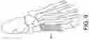 Fig. 10 - Minimally invasive surgery osteotomy fragment shifter, stabilizer, and targeter