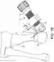 Fig. 11 - Minimally invasive surgery osteotomy fragment shifter, stabilizer, and targeter