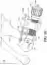 Fig. 21 - Minimally invasive surgery osteotomy fragment shifter, stabilizer, and targeter