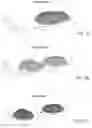 Fig. 11 - TISSUE TREATMENT SYSTEMS, DEVICES, AND METHODS