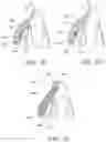 Fig. 05 - Orthodontic assembly