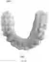 Fig. 17 - METHODS AND SYSTEMS FOR CREATING IMPROVED ORTHODONTIC ALIGNERS WITH TONGUE SPIKES