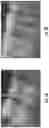 Fig. 03 - Subgingival medicament delivery tray