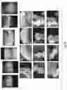 Fig. 12 - Subgingival medicament delivery tray