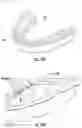 Fig. 17 - Subgingival medicament delivery tray