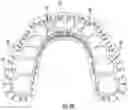 Fig. 19 - Subgingival medicament delivery tray