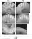 Fig. 20 - Subgingival medicament delivery tray