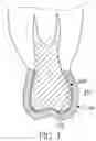 Fig. 04 - MEDICAMENT DELIVERY TOOTH COVERING