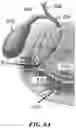 Fig. 11 - DEVICES, SYSTEMS, AND METHODS FOR TREATMENT OF DUCT OCCLUSION