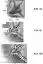 Fig. 12 - DEVICES, SYSTEMS, AND METHODS FOR TREATMENT OF DUCT OCCLUSION