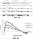 Fig. 24 - DEVICES, SYSTEMS, AND METHODS FOR TREATMENT OF DUCT OCCLUSION