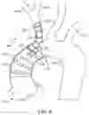 Fig. 04 - SUPRA AORTIC ACCESS TRIFURCATED MODULAR STENT ASSEMBLY AND METHOD