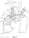 Fig. 05 - SUPRA AORTIC ACCESS TRIFURCATED MODULAR STENT ASSEMBLY AND METHOD