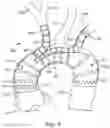 Fig. 06 - SUPRA AORTIC ACCESS TRIFURCATED MODULAR STENT ASSEMBLY AND METHOD