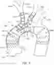 Fig. 07 - SUPRA AORTIC ACCESS TRIFURCATED MODULAR STENT ASSEMBLY AND METHOD