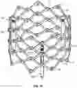 Fig. 17 - PROSTHETIC HEART VALVE HAVING NON-CYLINDRICAL FRAME