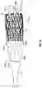 Fig. 23 - PROSTHETIC HEART VALVE HAVING NON-CYLINDRICAL FRAME