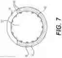 Fig. 08 - EXPANDABLE SHEATH WITH EXTRUDED SEGMENTS