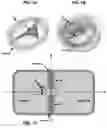 Fig. 02 - AN IMPLANTABLE DEVICE FOR REPAIRING A CARDIAC VALVE