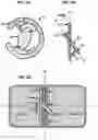 Fig. 05 - AN IMPLANTABLE DEVICE FOR REPAIRING A CARDIAC VALVE