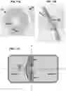 Fig. 27 - AN IMPLANTABLE DEVICE FOR REPAIRING A CARDIAC VALVE