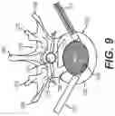 Fig. 11 - Coiling implantable prostheses and methods for implanting
