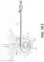 Fig. 35 - Coiling implantable prostheses and methods for implanting