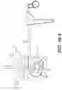 Fig. 36 - Coiling implantable prostheses and methods for implanting