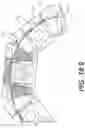 Fig. 65 - Coiling implantable prostheses and methods for implanting