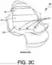 Fig. 07 - TALAR IMPLANT