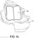 Fig. 13 - TALAR IMPLANT