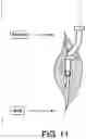 Fig. 09 - PROSTHETIC COMPONENT EXTRACTOR