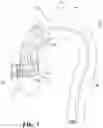 Fig. 08 - Landing zone for endovascular procedures
