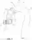 Fig. 10 - Landing zone for endovascular procedures