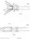 Fig. 11 - STENT GRAFT WITH A LONGITUDINAL SUPPORT MEMBER