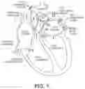 Fig. 02 - Loading systems for collapsible prosthetic heart valve devices and methods thereof
